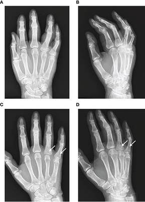 Senso-Immunologic Prospects for Complex Regional Pain Syndrome Treatment